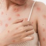 Dua Berita Viral Tentang Cacar Monyet Yang Ada Di Dunia