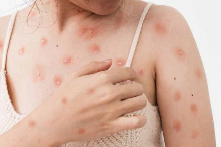 Dua Berita Viral Tentang Cacar Monyet Yang Ada Di Dunia